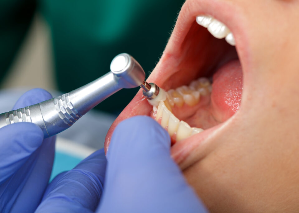 Teeth cleaning at Modern Touch Dental Glendale in Glendale, WI, using professional dental tools.