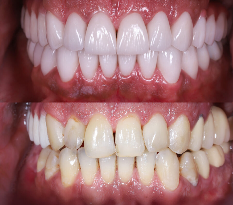 Dental veneers at Modern Touch Dental Glendale in Glendale, WI, for smile enhancement.