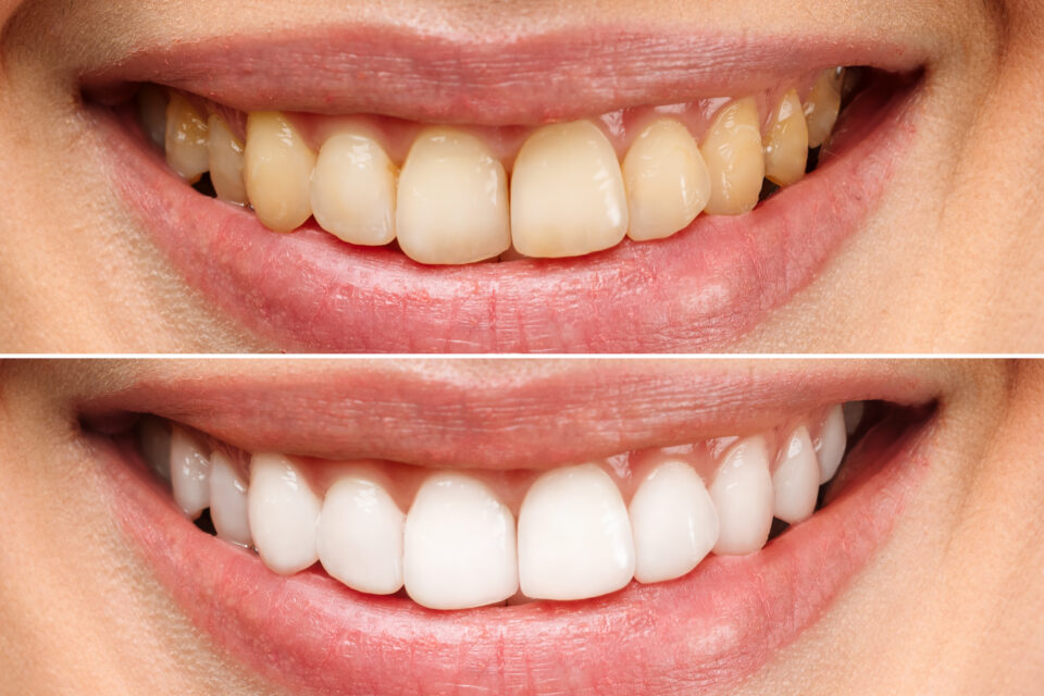 Teeth whitening results at Modern Touch Dental Glendale in Glendale, WI, before and after.