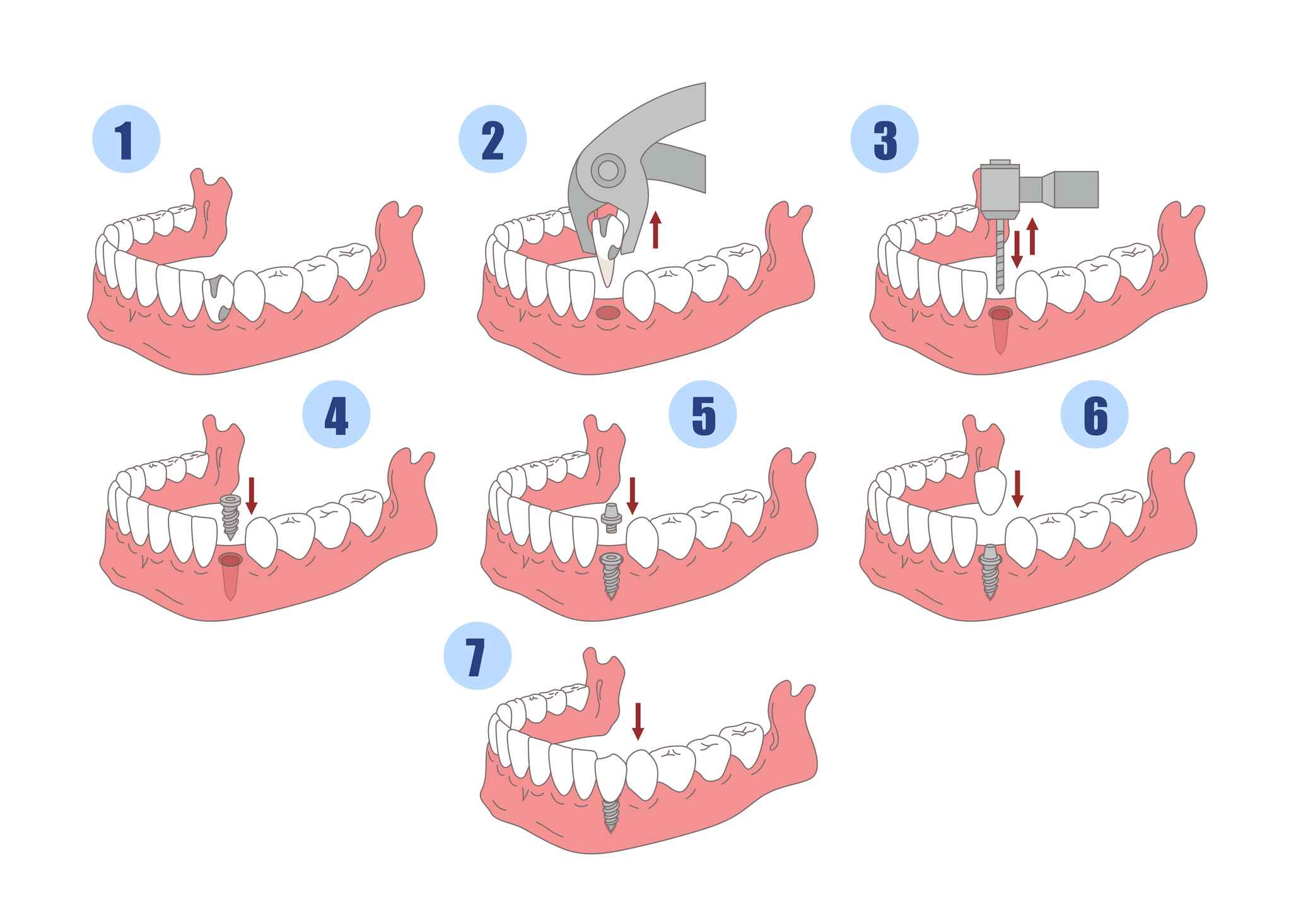 how to remove tobacco stains from dental implants Dental Implant Process From Start to Finish
