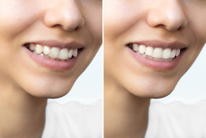 uneven teeth