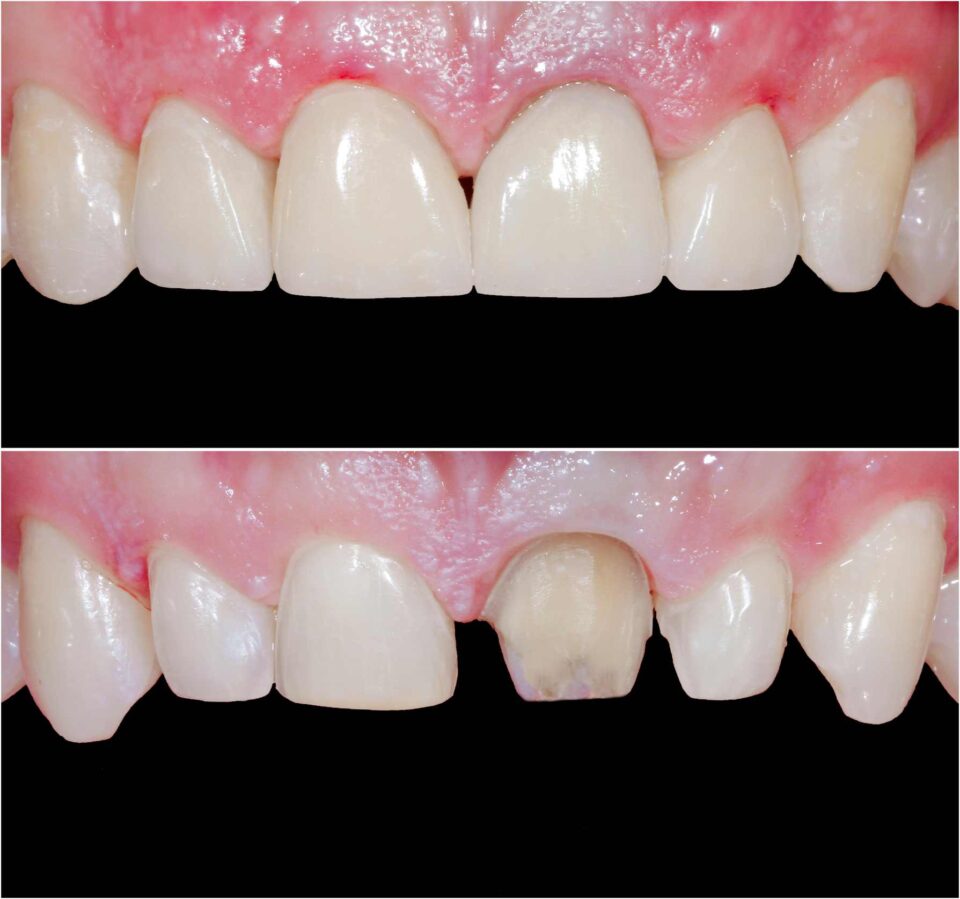 Before and after tooth reshaping treatment improving tooth appearance in Glendale, WI