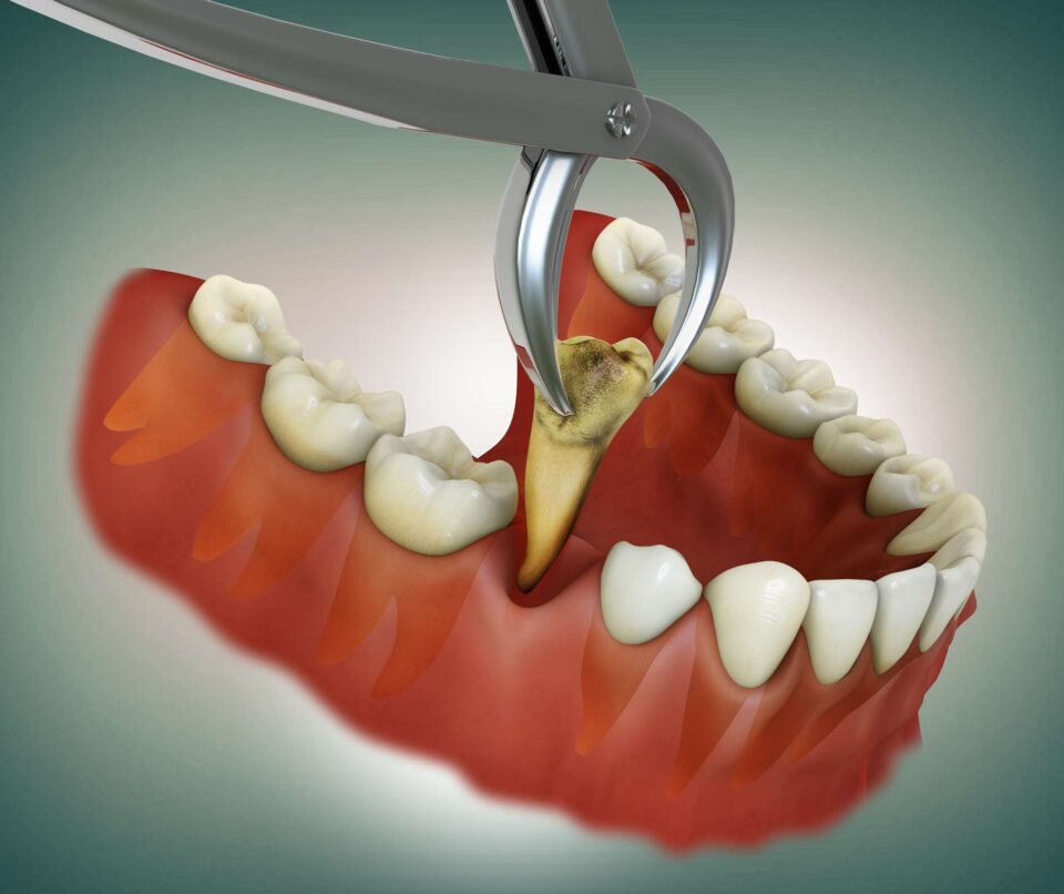 Illustration of tooth extraction procedure removing a damaged tooth in Glendale, WI